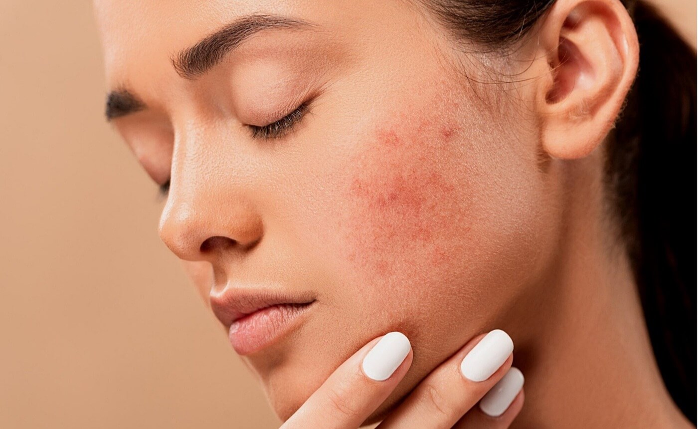 Does stress give you acne?